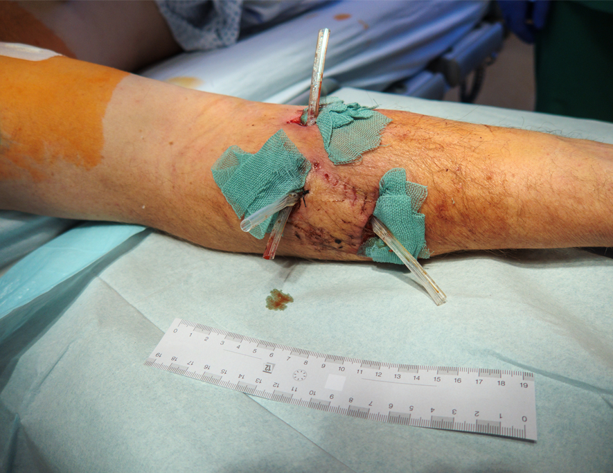 Person with visible arm injury from a dog bite, wrapped in gauze